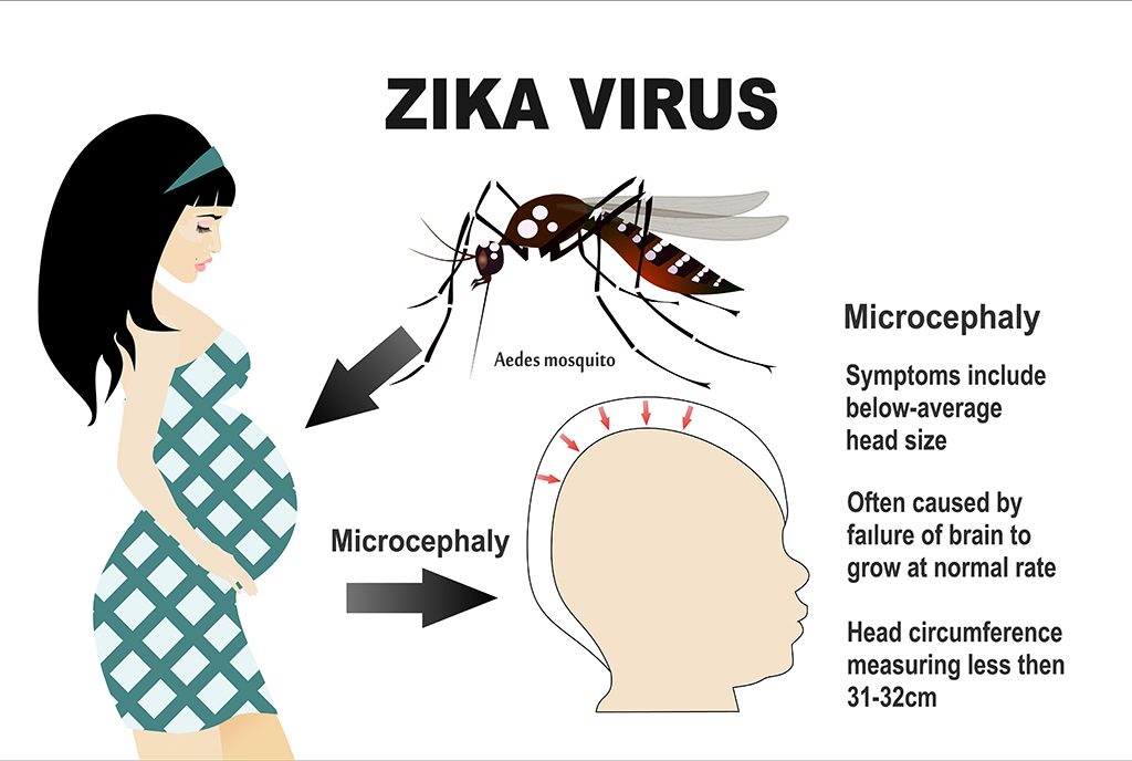zika-virus-study-birth-defects